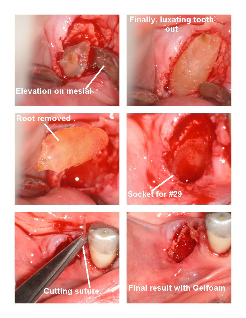 Osseous on extraction premolar pg 2.jpg